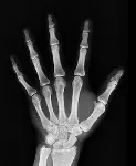 rontgenfoto hand